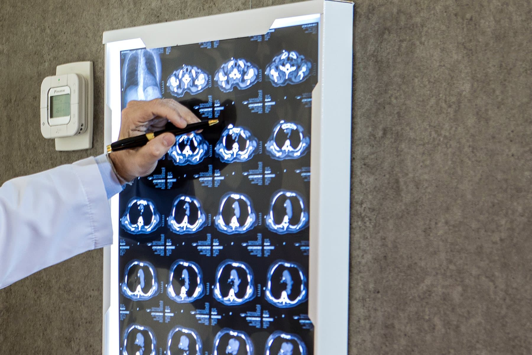 Cortes de tomografia de tórax sendo avaliados no negatoscópio
